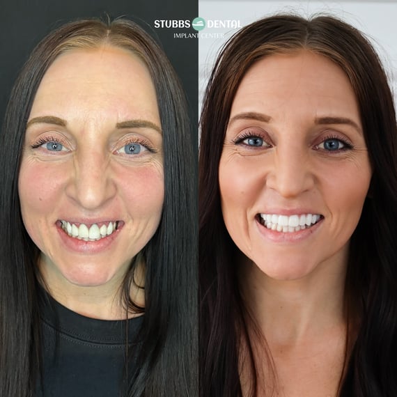 Rachael Huish - Before & After (Finals)
