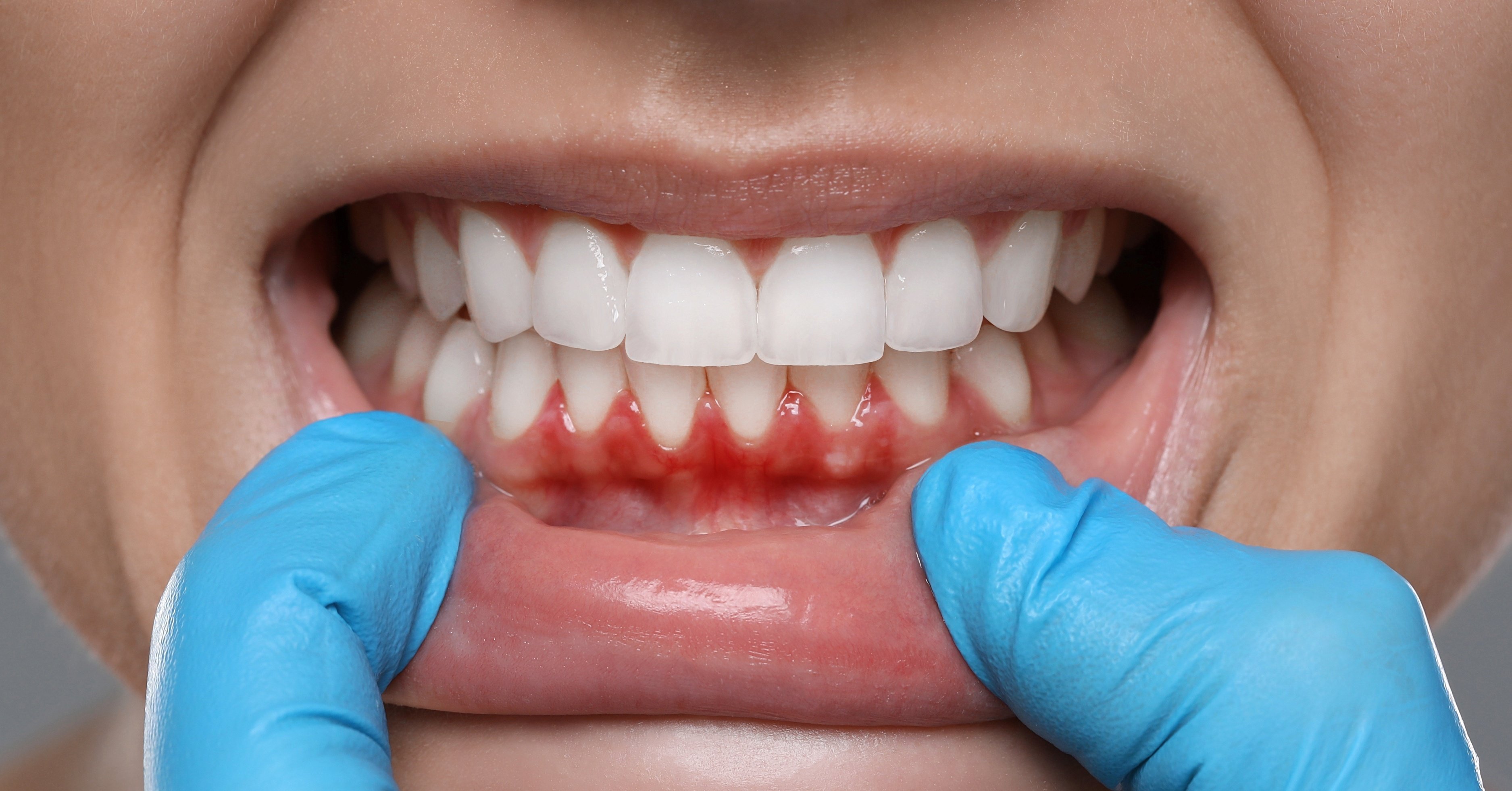 Patient in chair getting professional teeth cleaning