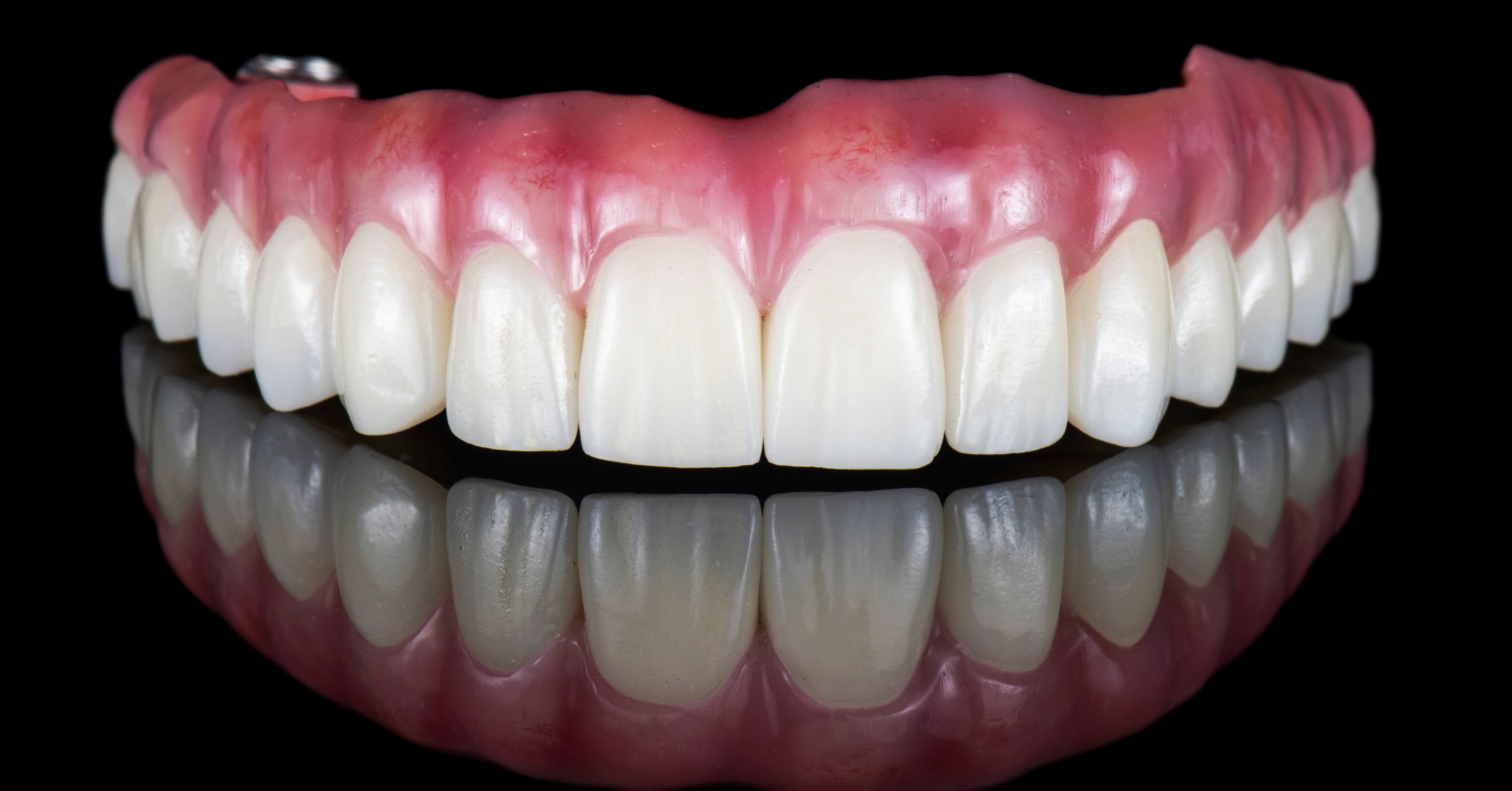 All-on-X Dental Implants, Dental Implants, Full-Mouth Restoration