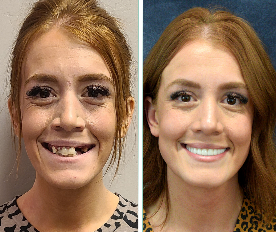 Permanent Teeth in 24 Hours at Stubbs Dental